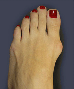 bunion_before