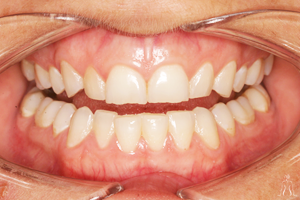 dental_implant_before